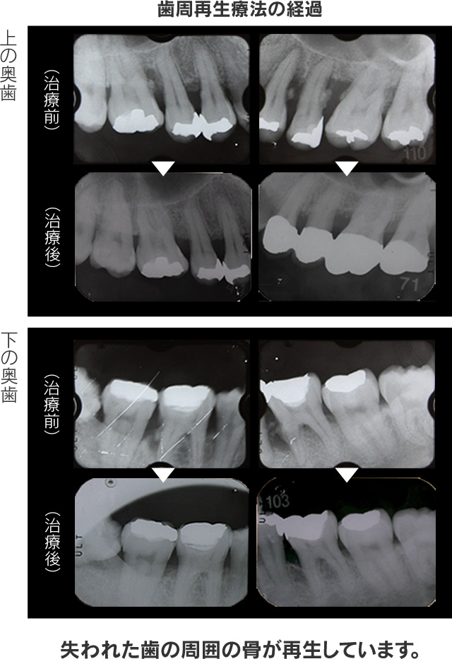 歯周病治療による治療例
