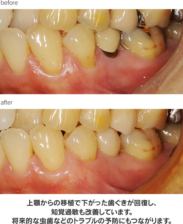 歯周病治療による治療例